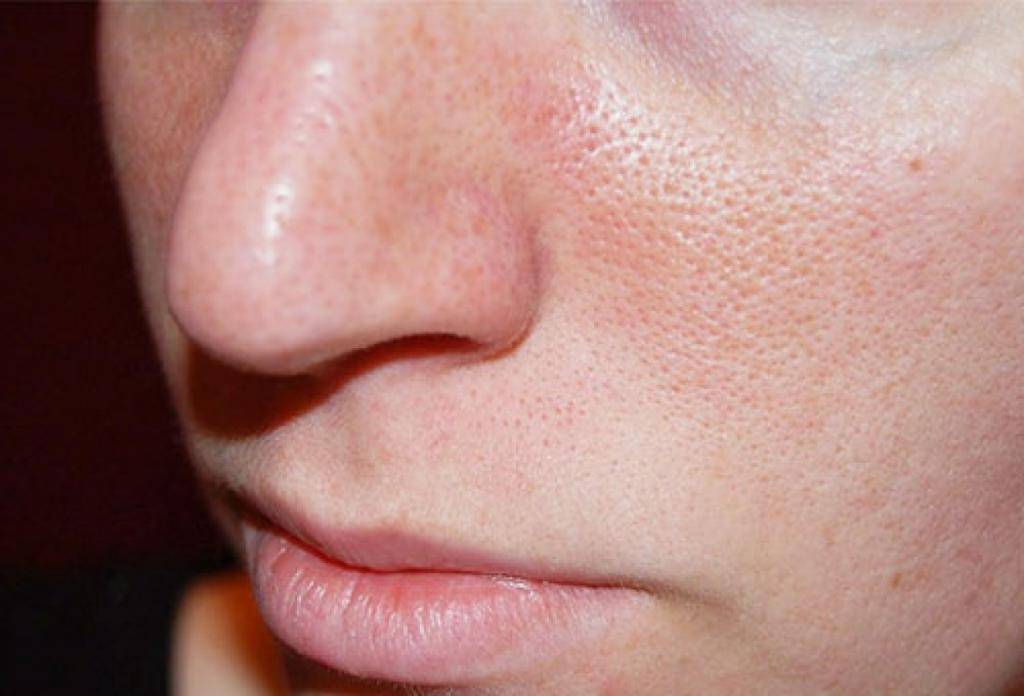Топ-15 методов как сузить поры на лице максимально быстро и эффективно