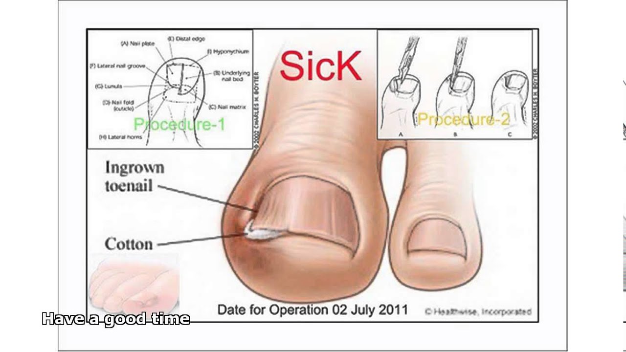 Вросший ноготь. причины, симптомы, диагностика и лечение вросшего ногтя.