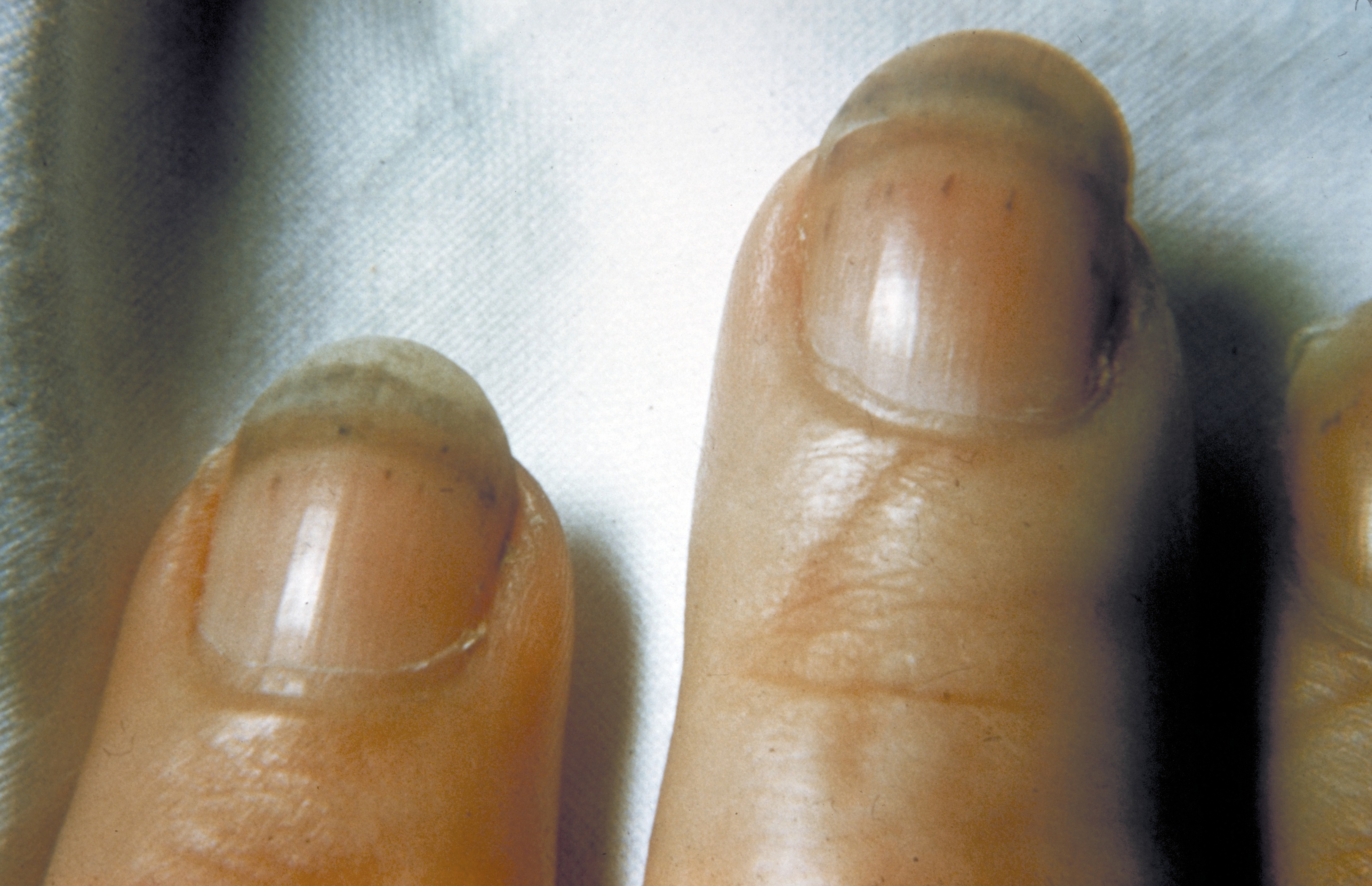Причины и лечение черных точек, светлых пятен и других изменений на ногтях рук и ног