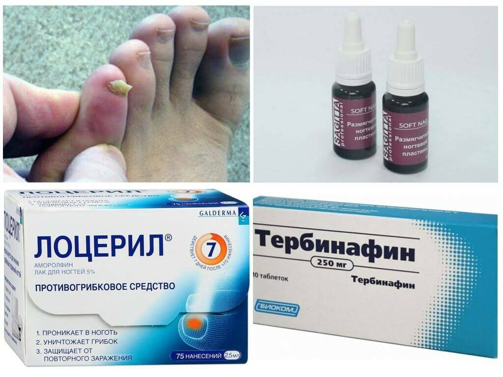 Симптомы и профилактика онихомитоза - medside.ru
