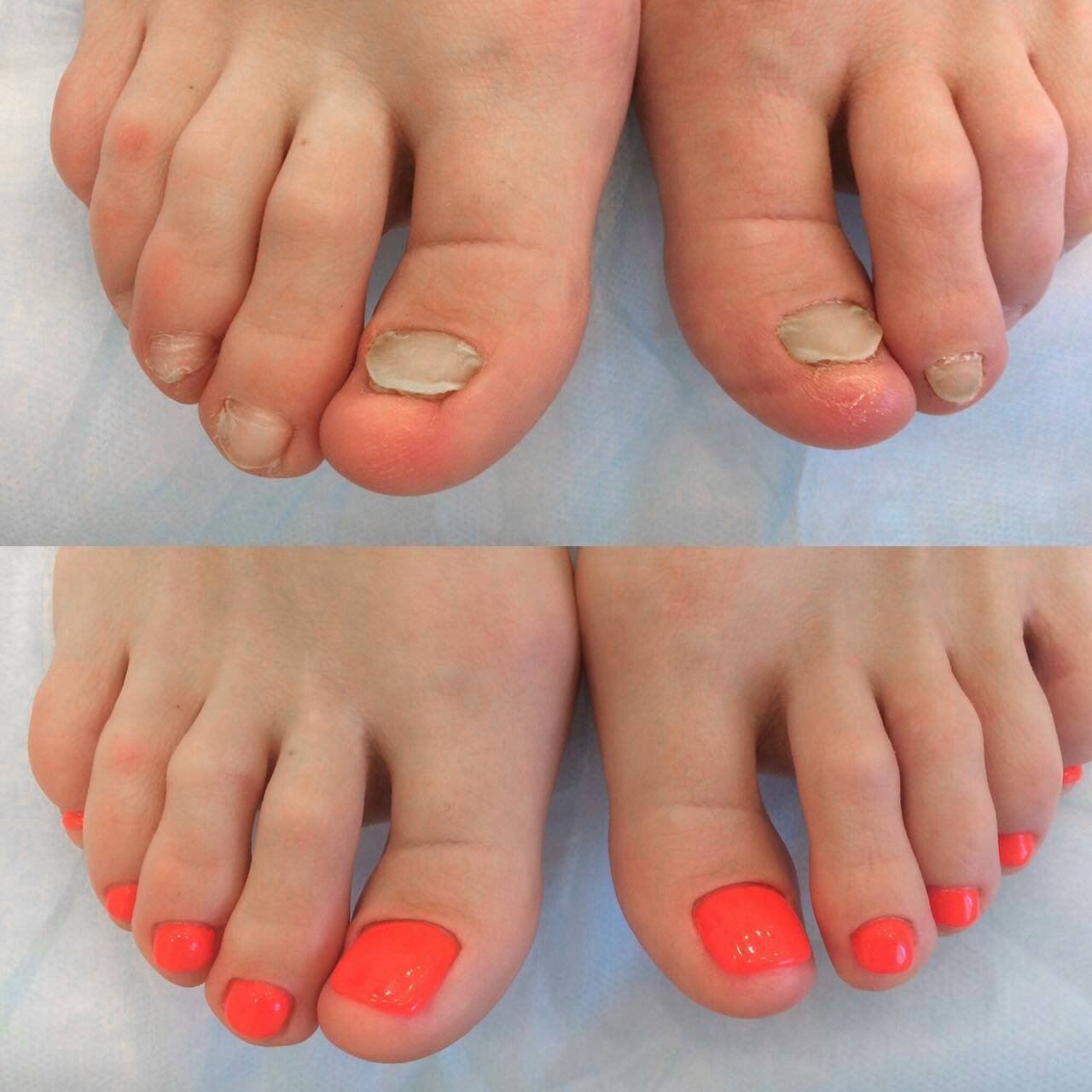 Протезирование ногтей спб избавит вас от эстетических проблем! nail clinic