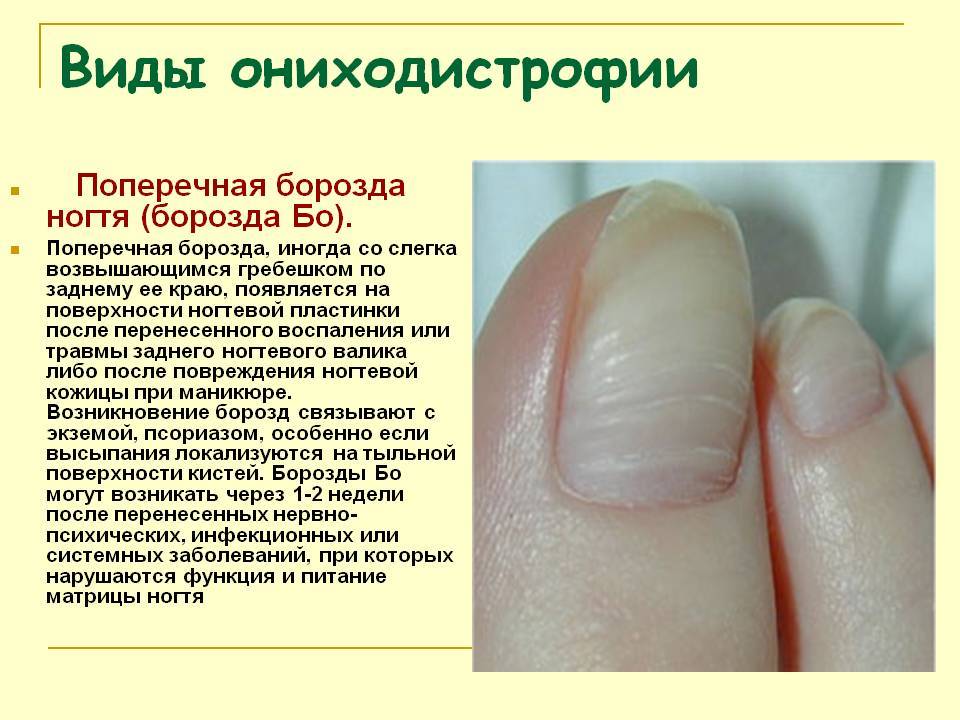 Полосы на ногтях - какие бывают и почему появляются, способы терапии, правила ухода и питания