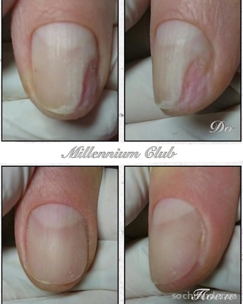 Как удлинить ногтевое ложе: действующие способы, особенности роста и строения ногтей, регулярность процедур по уходу за ногтями дома и в салоне