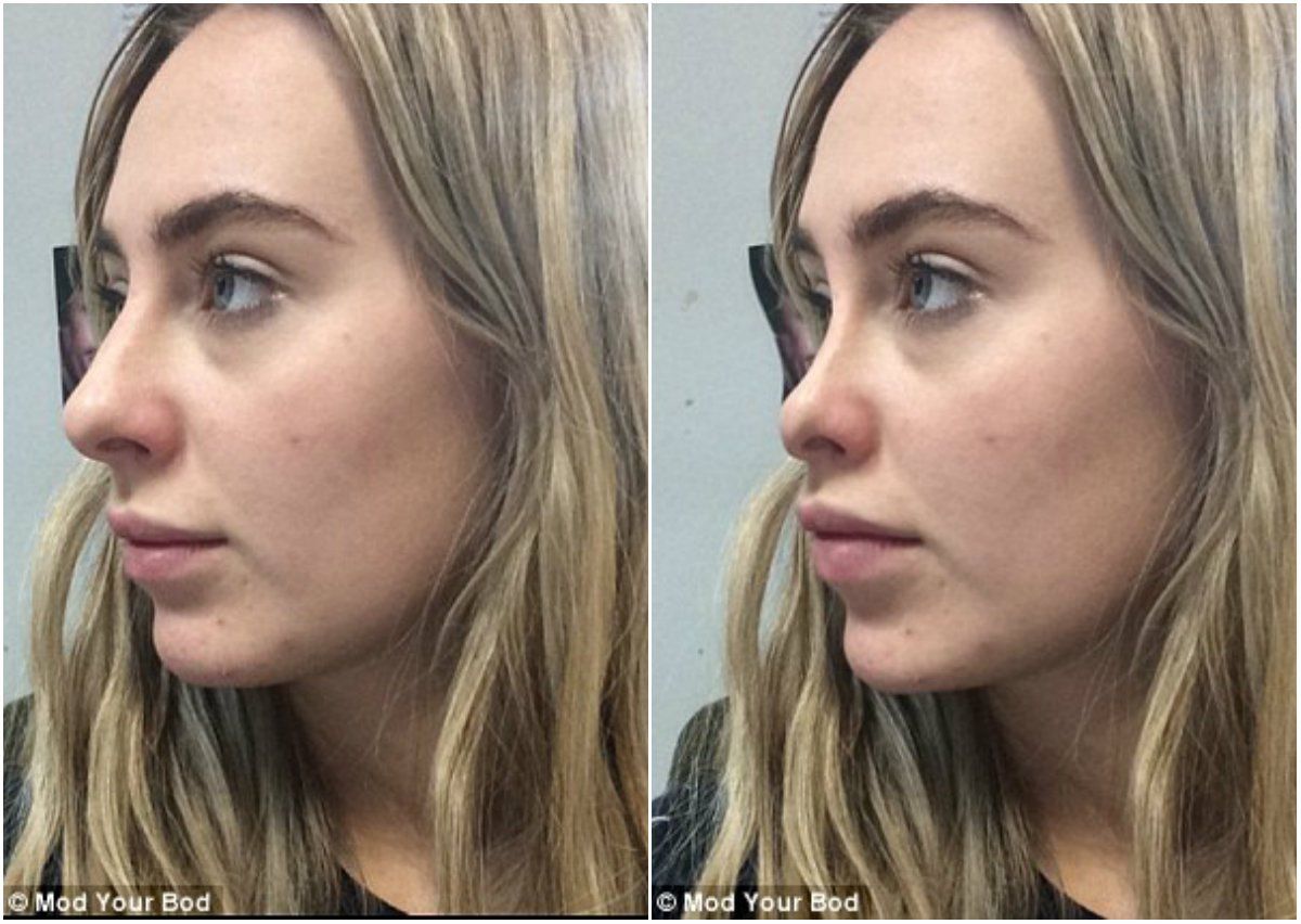 Курносый нос у девушки. как исправить, фото до и после ринопластики