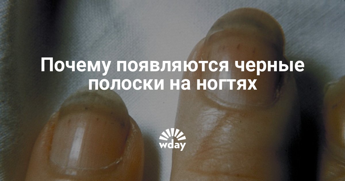 Полосы на ногтях вертикальные о чем говорят. Продольные черные полоски на ногтях. Продольная полоска на ногте большого пальца. Продольная черная полоса на ногте.