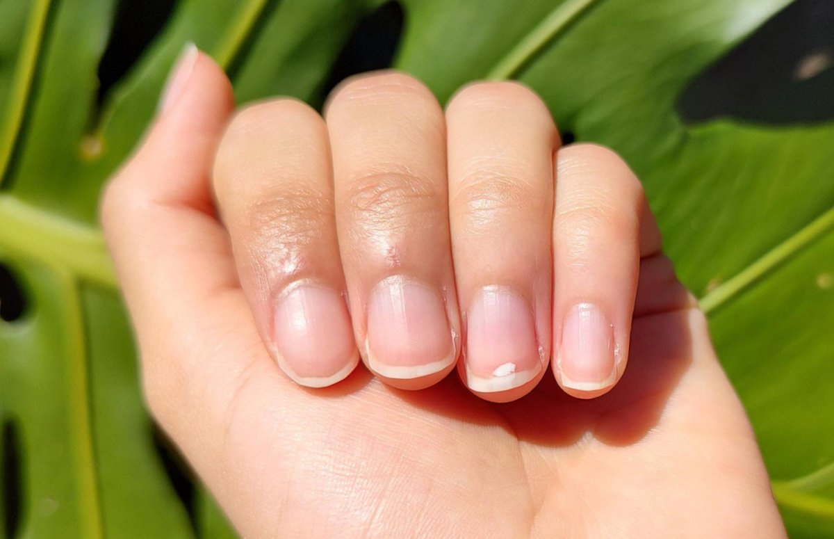 Лейконихия или белые пятна на ногтях​