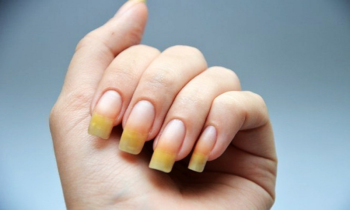 Почему желтеют ногти на руках